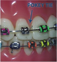 Braces Emergency: At-Home Fixes for Poking Wires #braces #learnontikto, braces are poking